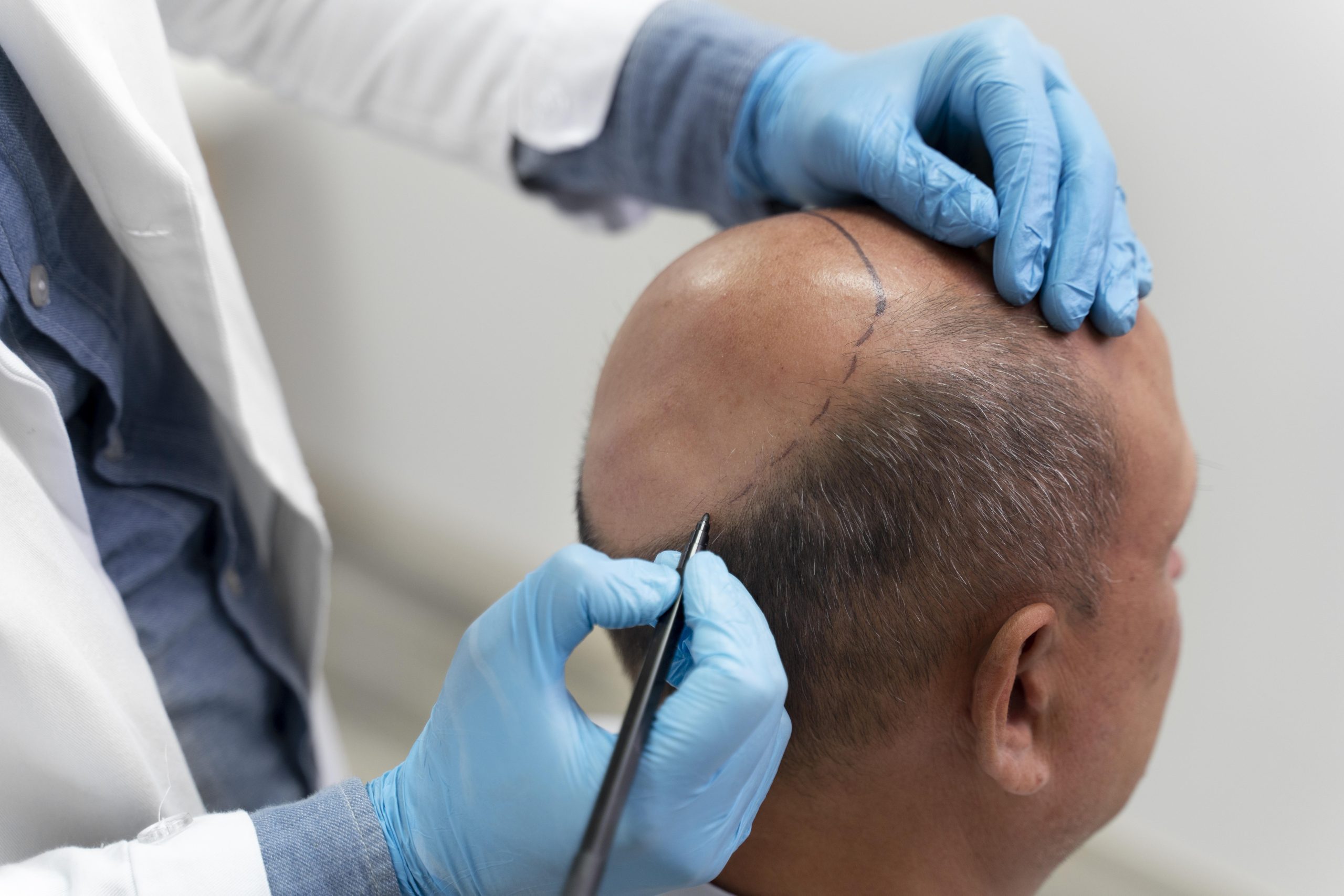 man-going-through-follicular-unit-extraction-process